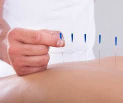 Experience Natural Healing with Acupuncture in Coquitlam post thumbnail image